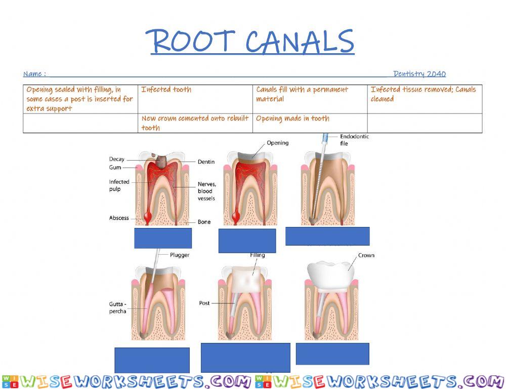 Root canal treatment